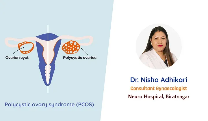 Polycystic Ovary Syndrome
