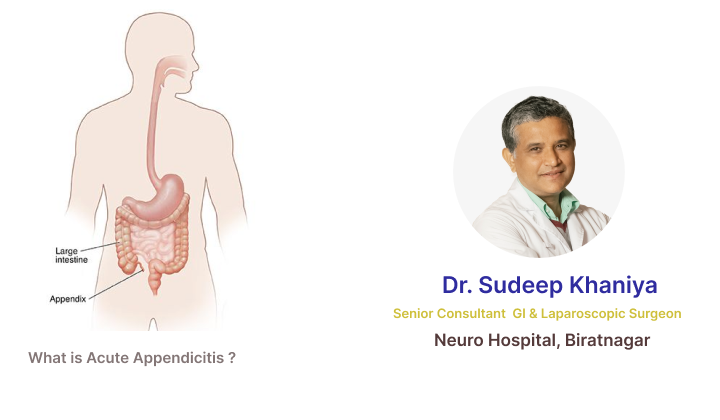What is Acute Appendicitis ?