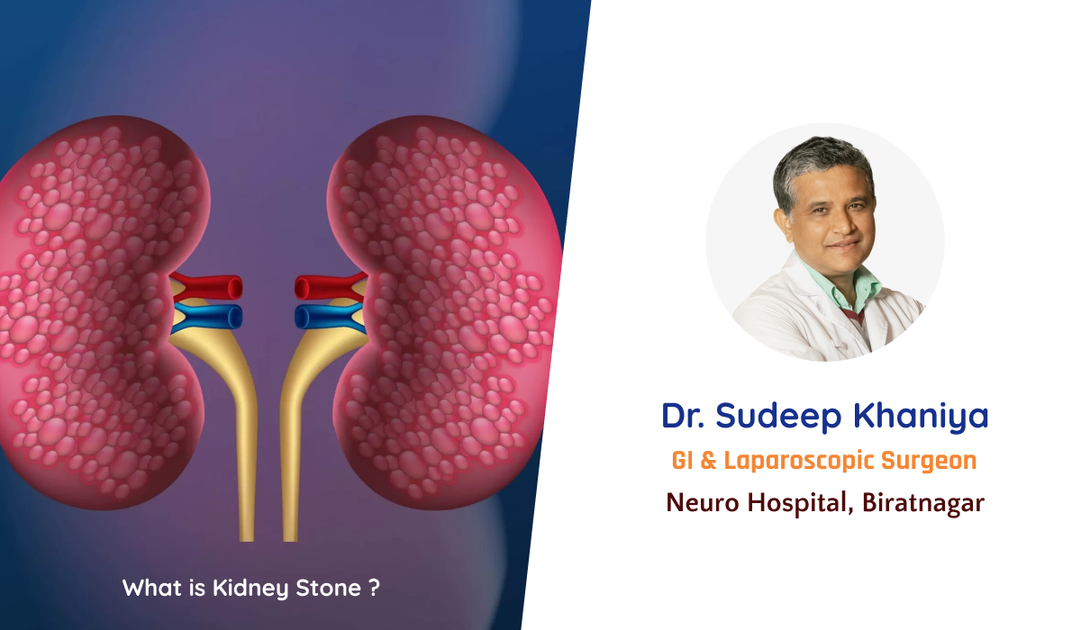 What is Kidney Stone?